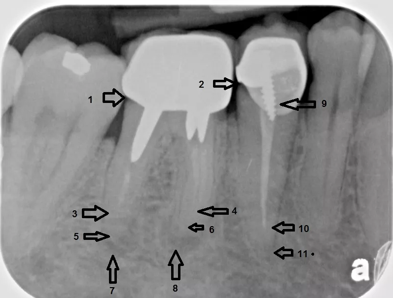 Root canal treatment