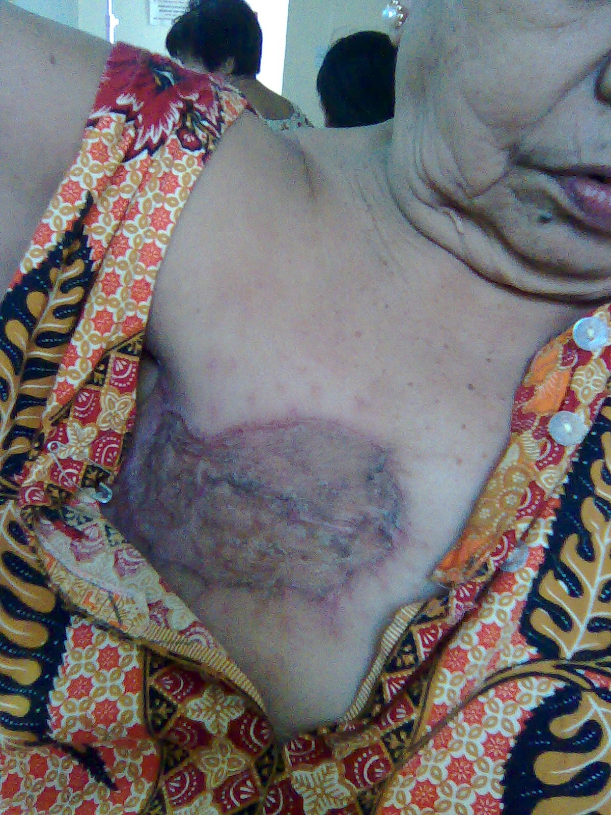 Skin grafting