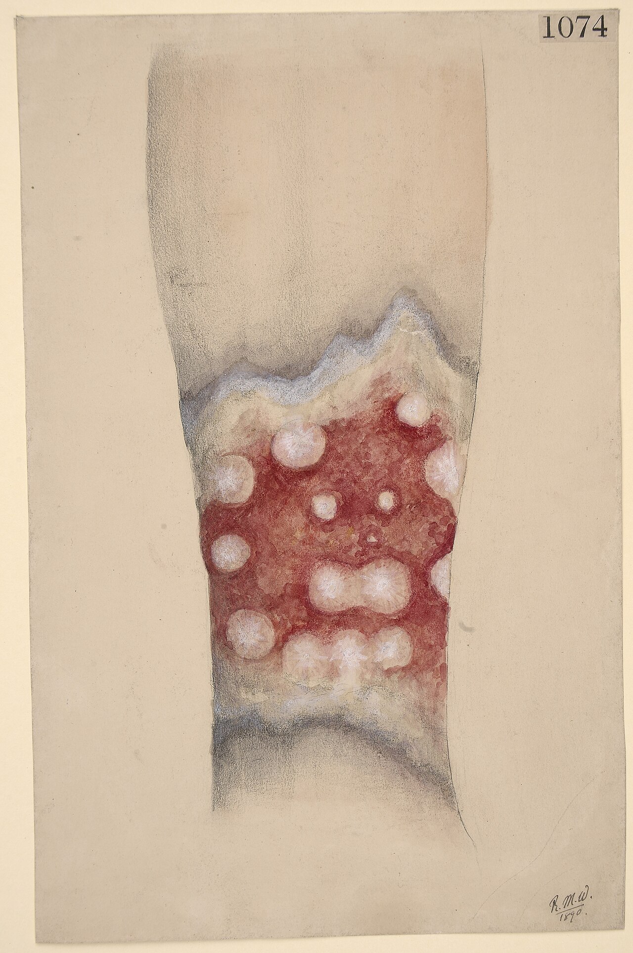 Skin grafting