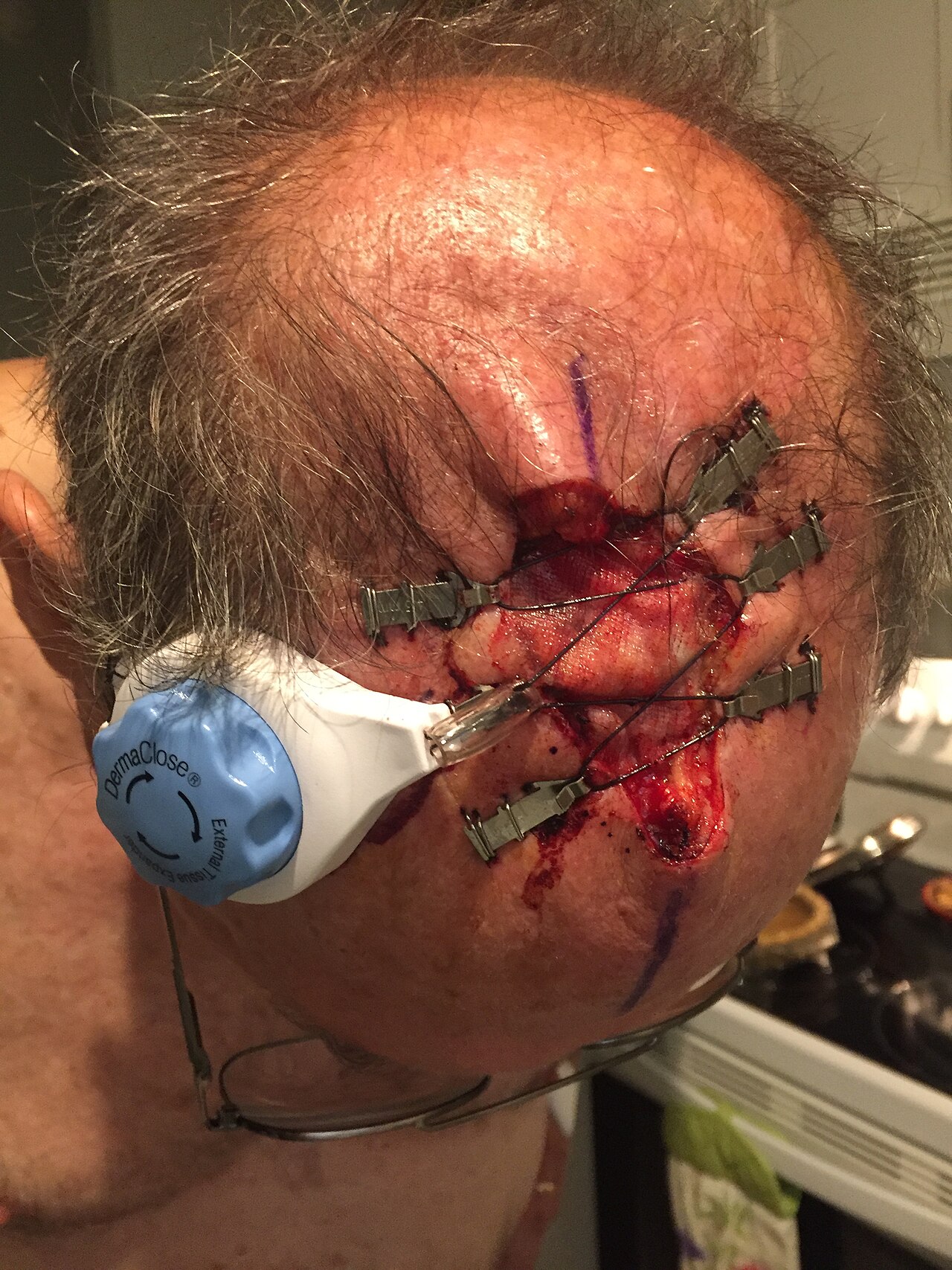 Skin grafting