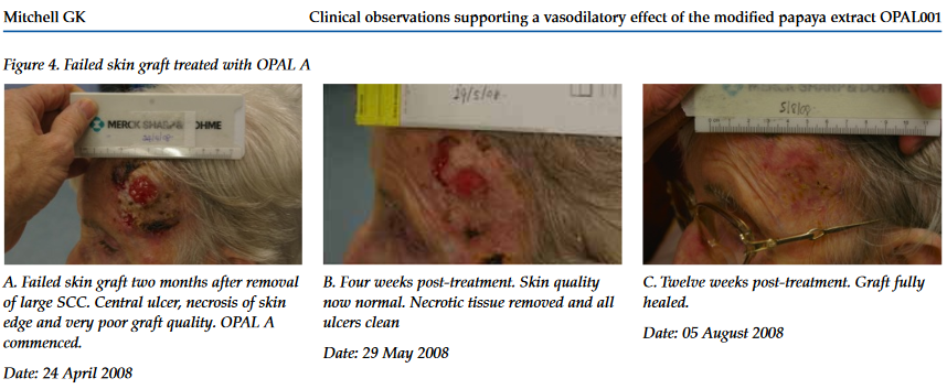 Skin grafting