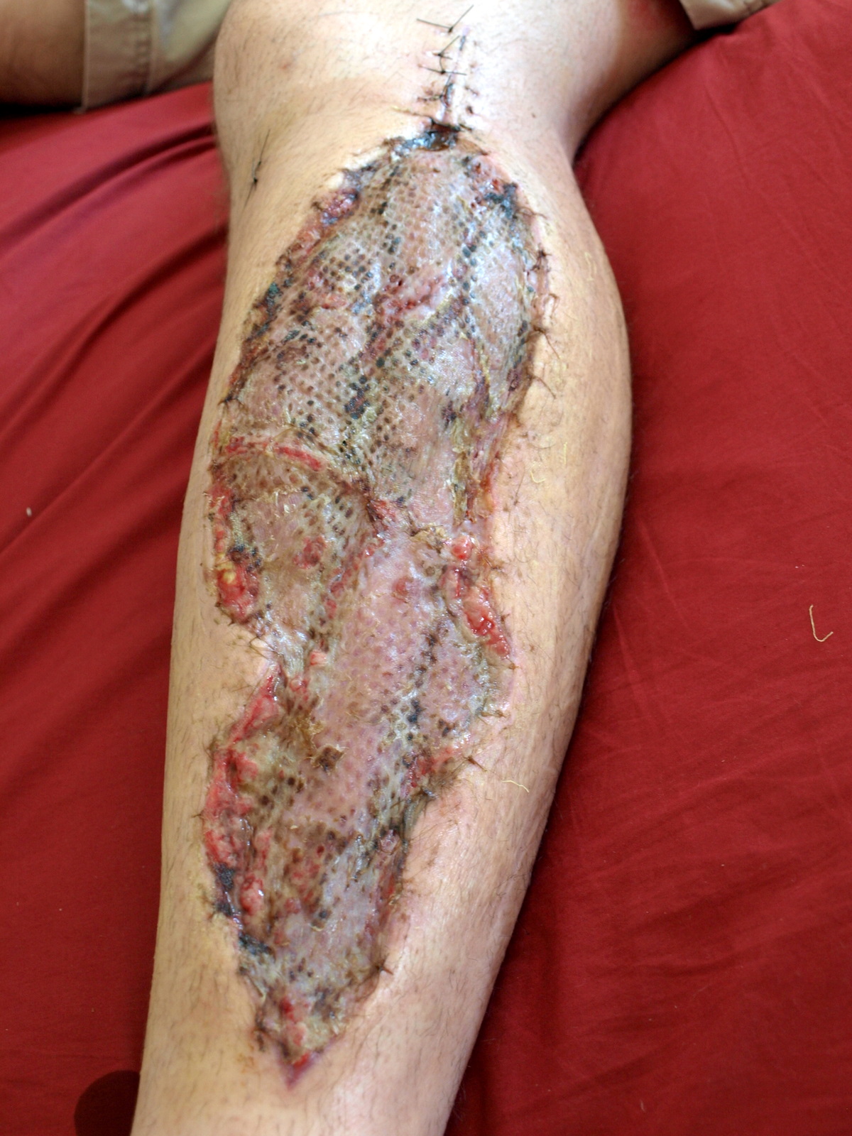 Skin grafting