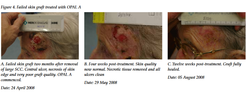 Skin grafting